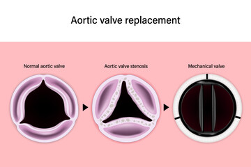Aortic valve replacement. Normal aortic valve. Aortic valve stenosis. Mechanical valve. Aortic valve repair. 