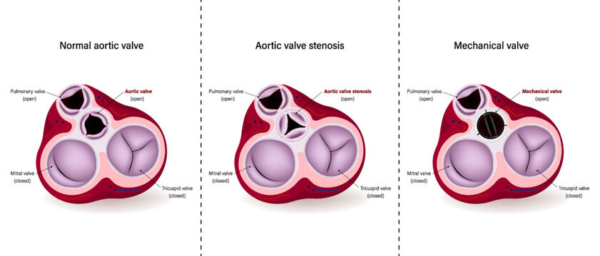 Diagram of Normal aortic valve, Aortic valve stenosis and Mechanical valve. Aortic valve repair. Aortic valve replacement.