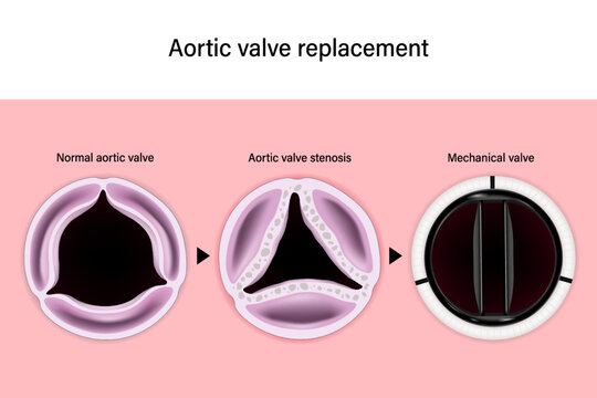 Aortic Valve Replacement. Normal Aortic Valve. Aortic Valve Stenosis. Mechanical Valve. Aortic Valve Repair. 