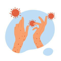 Monkeypox virus. Human hands with monkeypox. Skin infection concept. An outbreak of a smallpox pandemic. Vector illustration in cartoon style. Isolated on white background.	
 - obrazy, fototapety, plakaty