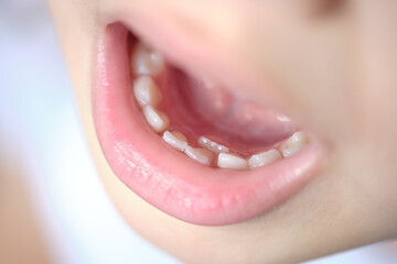 Open mouth of a child with milk teeth. Teeth in two rows. Shark tooth. The permanent incisors grew before the milk teeth fell out.