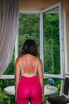 A girl with a bare back, badly burned in the sun looks out the window