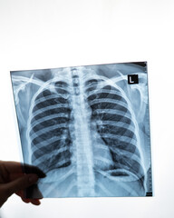 Doctor showing x-ray of patient's lungs. 