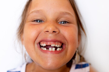 Toothless smiling, glad, mischievous little blonde girl show baby temporary milk teeth on white view. Crooked teeth, bad dental occlusion. Hygiene problem. Orthodontic and stomatology work, medicine
