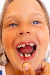 Vertical little girl with open toothless mouth with crooked teeth and fresh wound bleeding gingiva. Stomatological appointment, dentist hand examining temporary milk teeth condition. Teeth loss