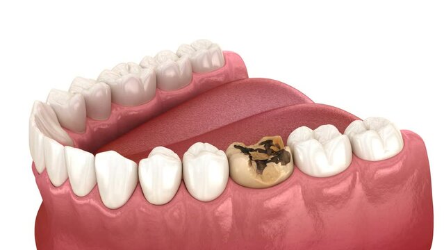 Caries removing, preparation, dental impression and crown placement. 3D animation
