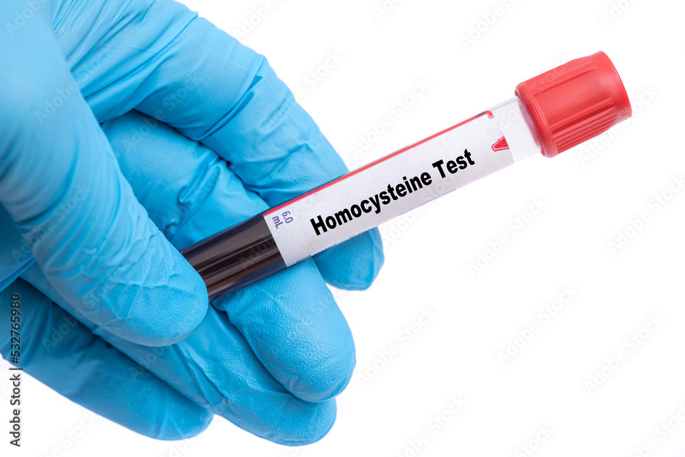 Sticker homocysteine test medical check up test tube with biological sample