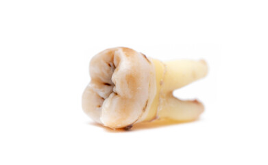 Close-up of a tooth with caries isolated on a white background. Removed wisdom teeth. Sick human teeth.