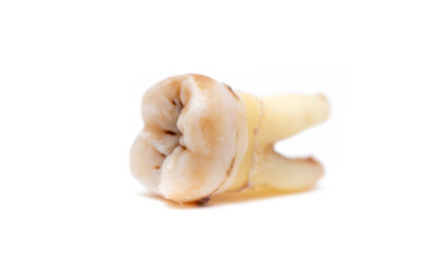 Close-up of a tooth with caries isolated on a white background. Removed wisdom teeth. Sick human...