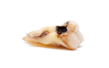 Close-up of a tooth with caries isolated on a white background. Removed wisdom teeth. Sick human teeth.