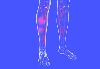 Transparent anatomical 3d illustration of the human legs. Showing the venous system with varicose veins and eczema. - obrazy, fototapety, plakaty
