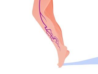 3d illustration of the venous system with varicose veins in one leg. Flat rendering of anatomy.