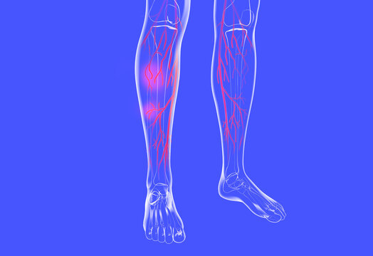 Transparent anatomical 3d illustration of the human legs. Showing the venous system with varicose veins and eczema.