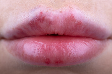 Obraz premium Marks bruising after collagen injections or fillers on Woman lips close-up.