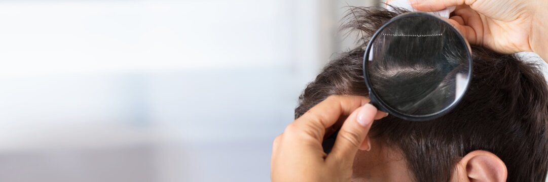 Dermatologist Checking Patient's Hair With Magnifying Glass