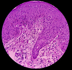 Skin tissue(biopsy): Pityriasis lichenoids chronica, a group of rare acquired inflammatory skin...