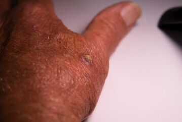 Hand of a 75-year-old Caucasian man with wart or cutaneous horn, which is an outgrowth of compact keratin.