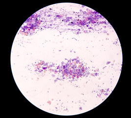 Microscopic view of PAP'S smear showing severe negative for intraepithelial lesion malignancy (NILM). cervical cancer diagnosis.