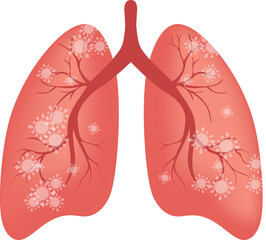 COVID-2019 coronavirus. lungs infected by coronavirus. Pneumonia or respiratory distress syndrome.