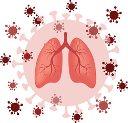 COVID-2019 coronavirus. lungs infected by coronavirus. Pneumonia or respiratory distress syndrome.