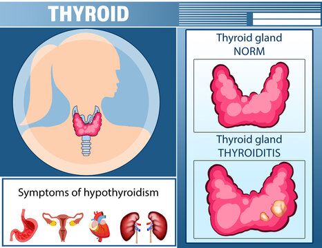 Illustration of thyroid gland and symptoms of hypothyroidism. Medical poster