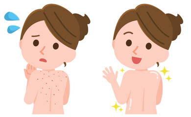 背中ニキビに悩む女性　きれいに治る女性　イラスト