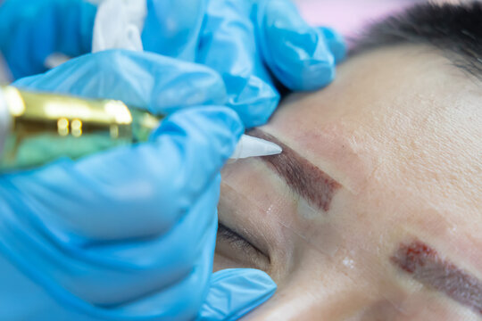 Asian Woman with Permanent Tattoo Eyebrow Removal Process