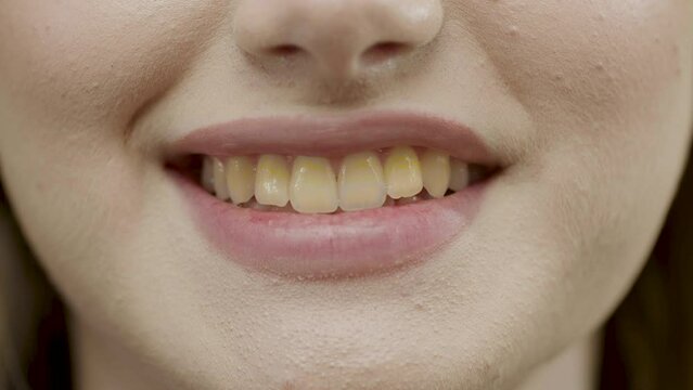 Woman smiling broadly in the room. Close up image. dirty teeth before the care procedure. Wide smile, clear skin, natural lips. Concept of teeth care and cleaning procedures