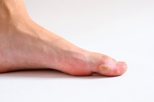Large wart on toe. Leg with a wart close-up on a white background.