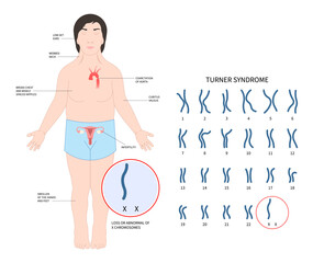 Turner and fragile syndrome of the X chromosomal abnormality test genetic with gonadal dysgenesis disorder in female - obrazy, fototapety, plakaty