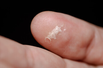 Callus on the thumb of a man. Mechanical damage to the skin. Blister on a man's hand. Problems of dermatology. Black background