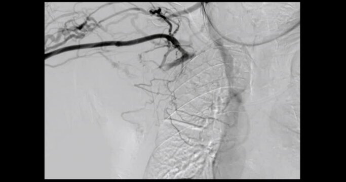 Angiogram balloon dialysis catheter inflated at Arteriovenous (AV) graft for dilated vessel from patient hemodialysis in end stage renal disease (ESRD).