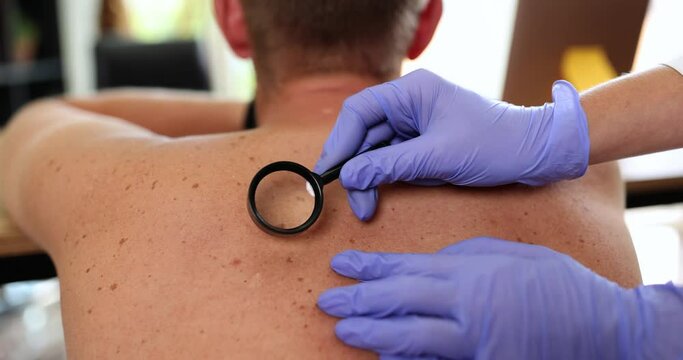Doctor examines neoplasms on skin of adult back with magnifying glass