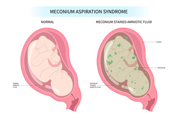 Meconium aspiration syndrome in fetal care and womb	