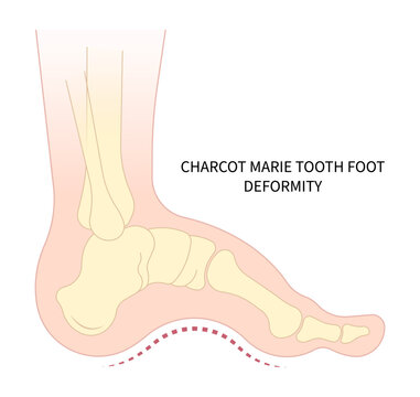 Charcot foot anatomy Bone fracture painful and diabetic gout disease sores leg and Pes Cavus arches of Cavovarus hammer toes