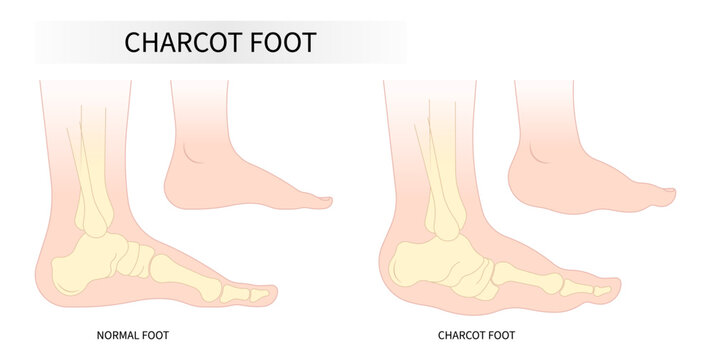 Bone fracture of the Charcot foot anatomy painful and diabetic gout disease sores leg and Pes Cavus arches of Cavovarus hammer toes