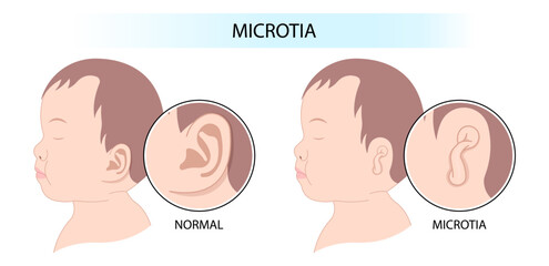 Before and after surgery of Abnormal shape with newborn ear - obrazy, fototapety, plakaty