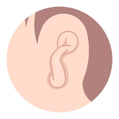 Abnormal shape of newborn ear