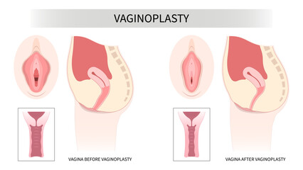 Female women genital of minor Vulval labia loose lips beauty surgery to tighten Hood Dry vagina disease and posterior colporrhaphy reconstruction male by the Vulvoplasty Dyspareunia pain menopause