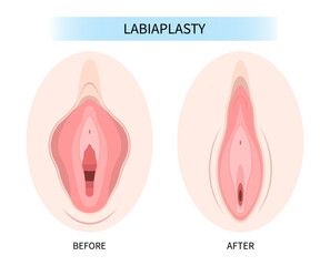 menopause vagina disease Female women genital of minor Vulval labia loose lips beauty surgery to tighten Hood Dry and posterior colporrhaphy reconstruction male by the Vulvoplasty Dyspareunia pain