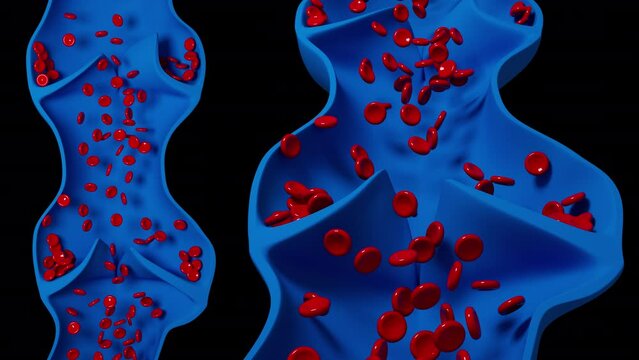 Varicose Veins Blood Flow