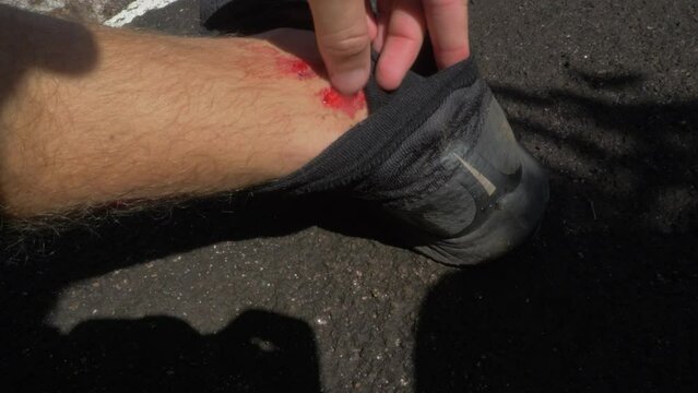 Man Open His Sock And Found The Leech Sucking Blood On His Foot. - close up