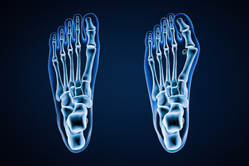 Hallux Valgus or bunion x-ray 3D rendering illustration. Dorsal or top view of human healthy and injured left foot on blue background. Anatomy, osteology, pahtology, orthopedics concept. - obrazy, fototapety, plakaty