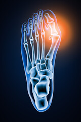 Hallux Valgus or bunion 3D rendering illustration. Superior or dorsal view of accurate human left foot bones with body contours on blue background. Anatomy, osteology, pahtology, orthopedics concept. - obrazy, fototapety, plakaty