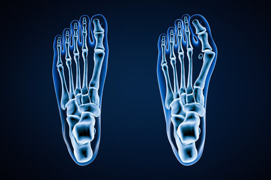 Hallux Valgus or bunion x-ray 3D rendering illustration. Dorsal or top view of human healthy and injured left foot on blue background. Anatomy, osteology, pahtology, orthopedics concept.