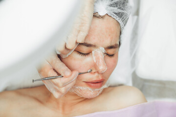 Cosmetic facial cleansing procedure for a young woman using a spoon uno. acne treatment. mechanical...