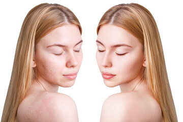 Young woman before and after acne treatment.