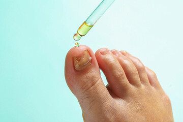 Application of oil for the care of damaged nail which is strengthened with titanium thread