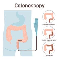 Colonoscopy. Medical diagnostics of the large intestine. Gastrointestinal