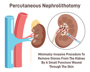 Percutaneous nephrolithotomy. Kidney stone removing surgery. Nephrolithiasis
